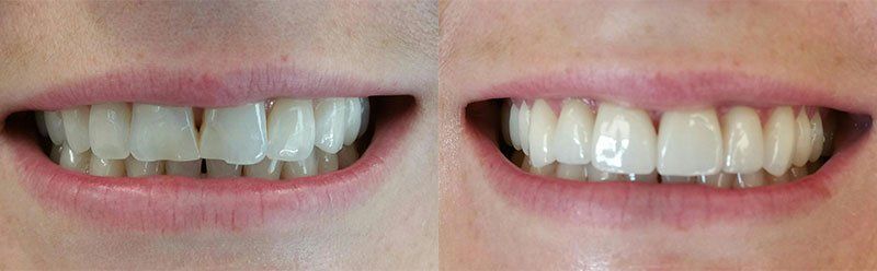 Smile makeover