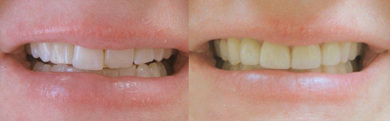 Smile makeover