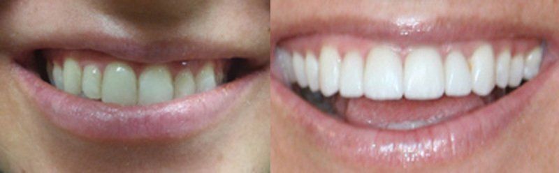 Smile makeover