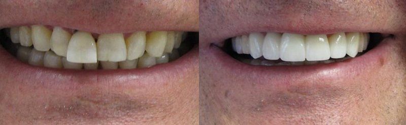 Smile makeover