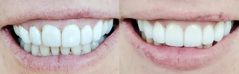 Smile makeover