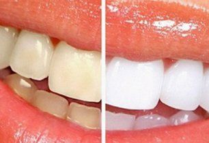 Closeup of teeth - before and after whitening