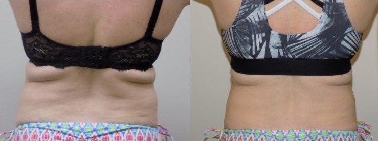 Before and after photo of a woman who received an UltraSlim treatment