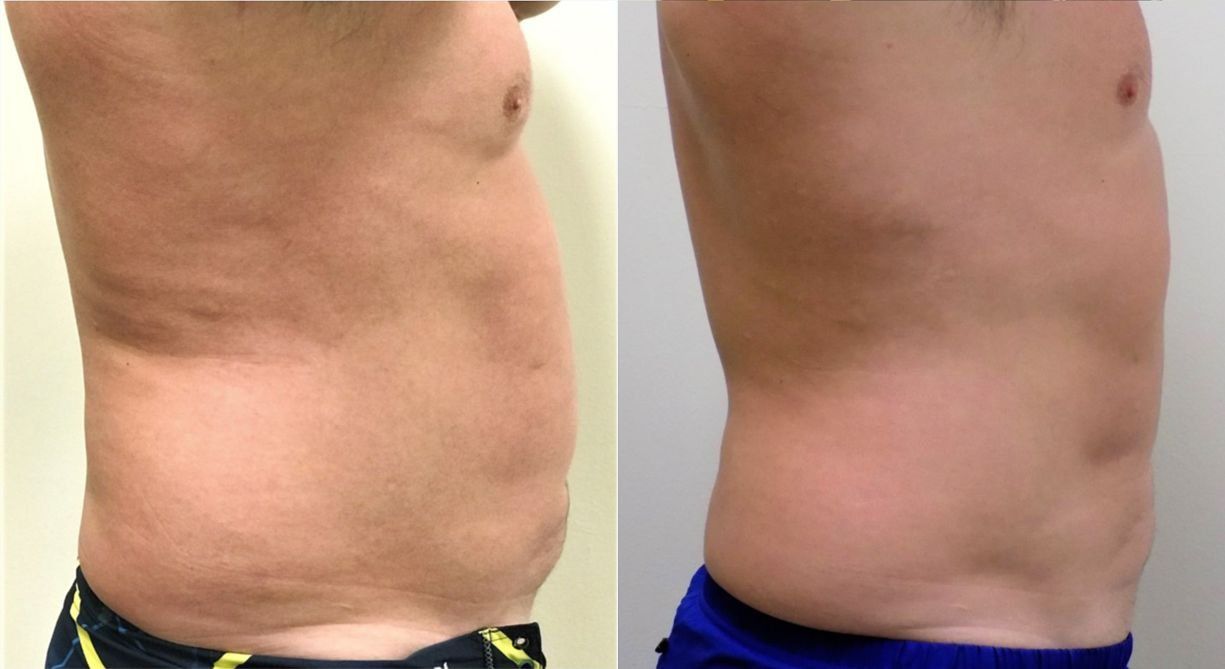 Before and after photo of a man who received an UltraSlim treatment