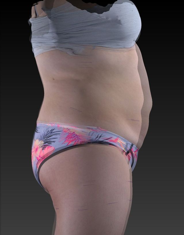 $79 UltraSlim® TV Special!  Kansas City Laser-Like Lipo®