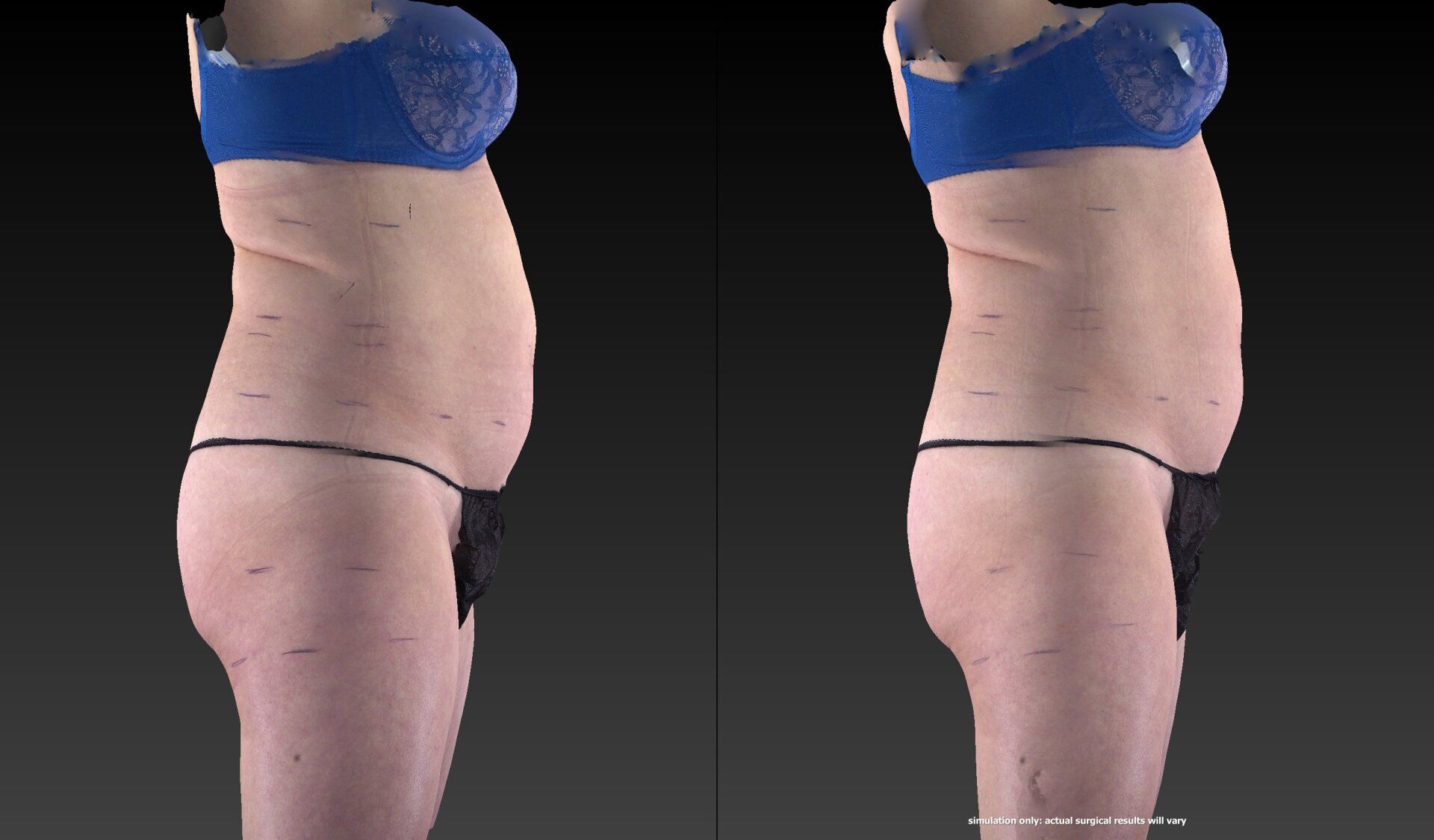 Before and after photo of a woman who received an UltraSlim treatment