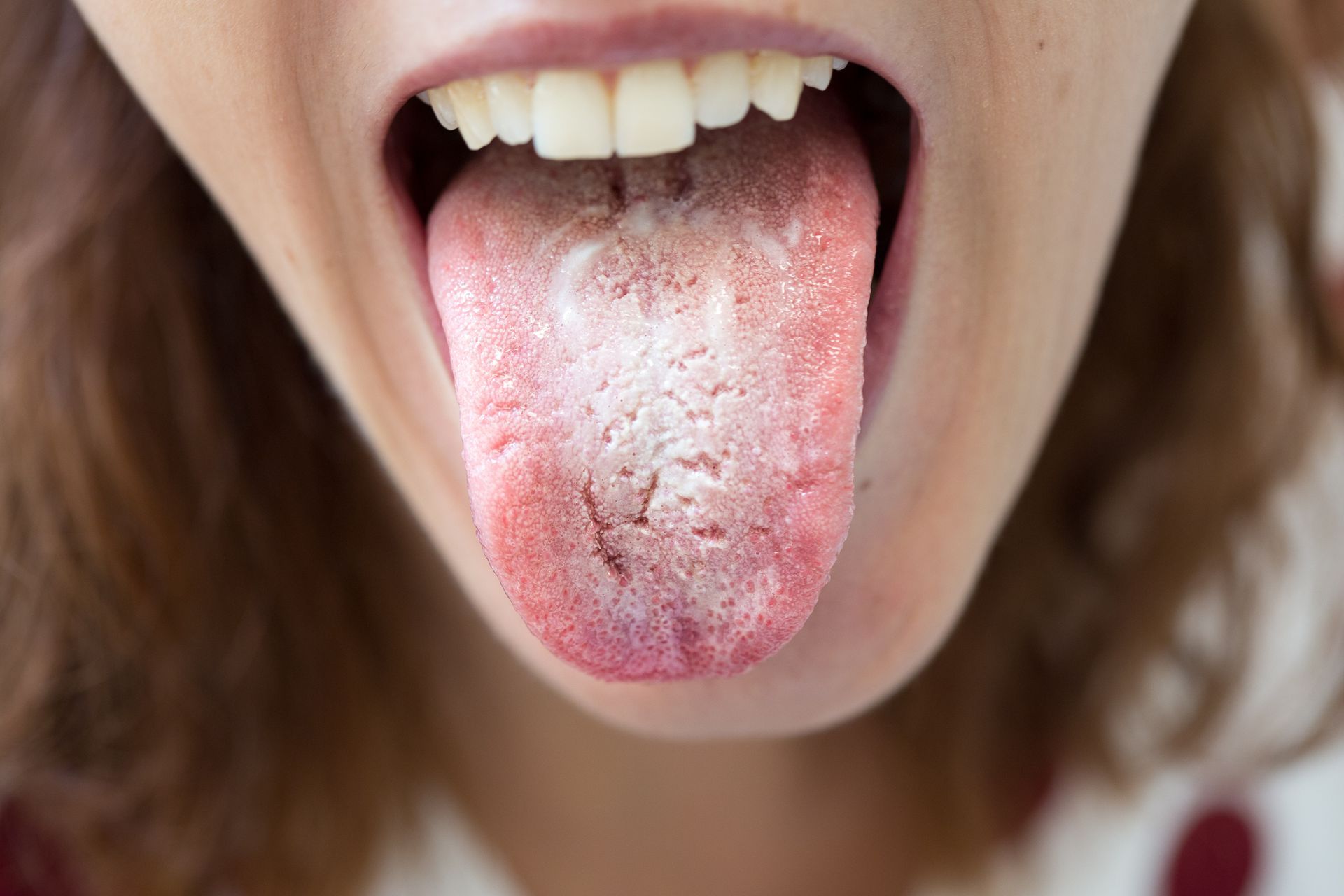 A woman with candida growing on her tounge