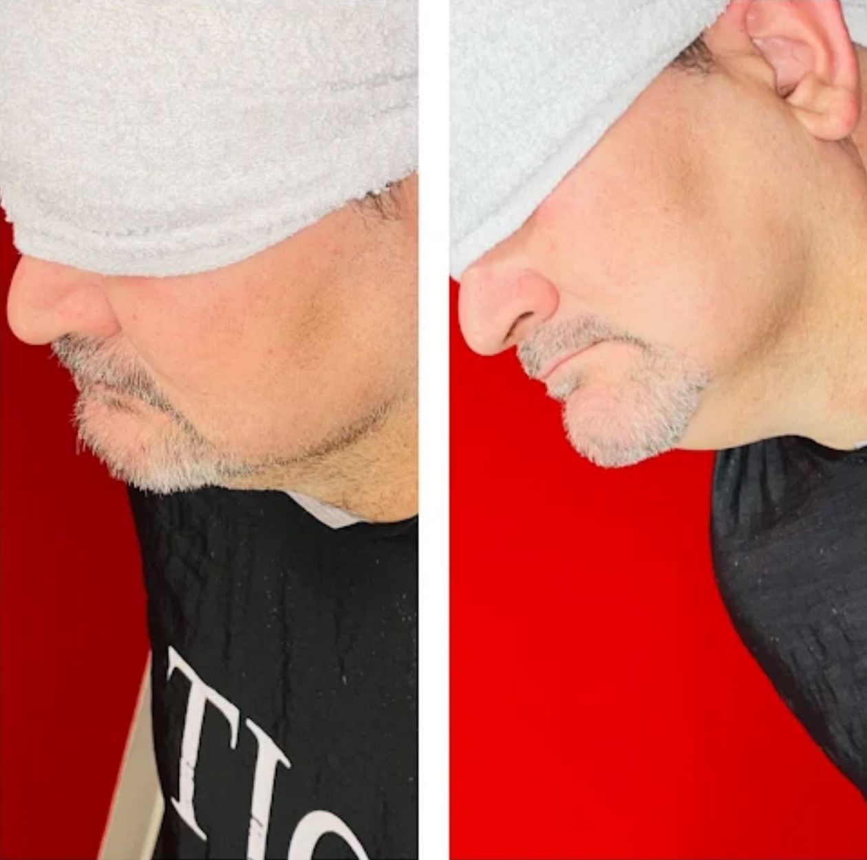 Side-by-side comparison of a man's profile; before and after a procedure. Red background, grey hat, grey stubble.