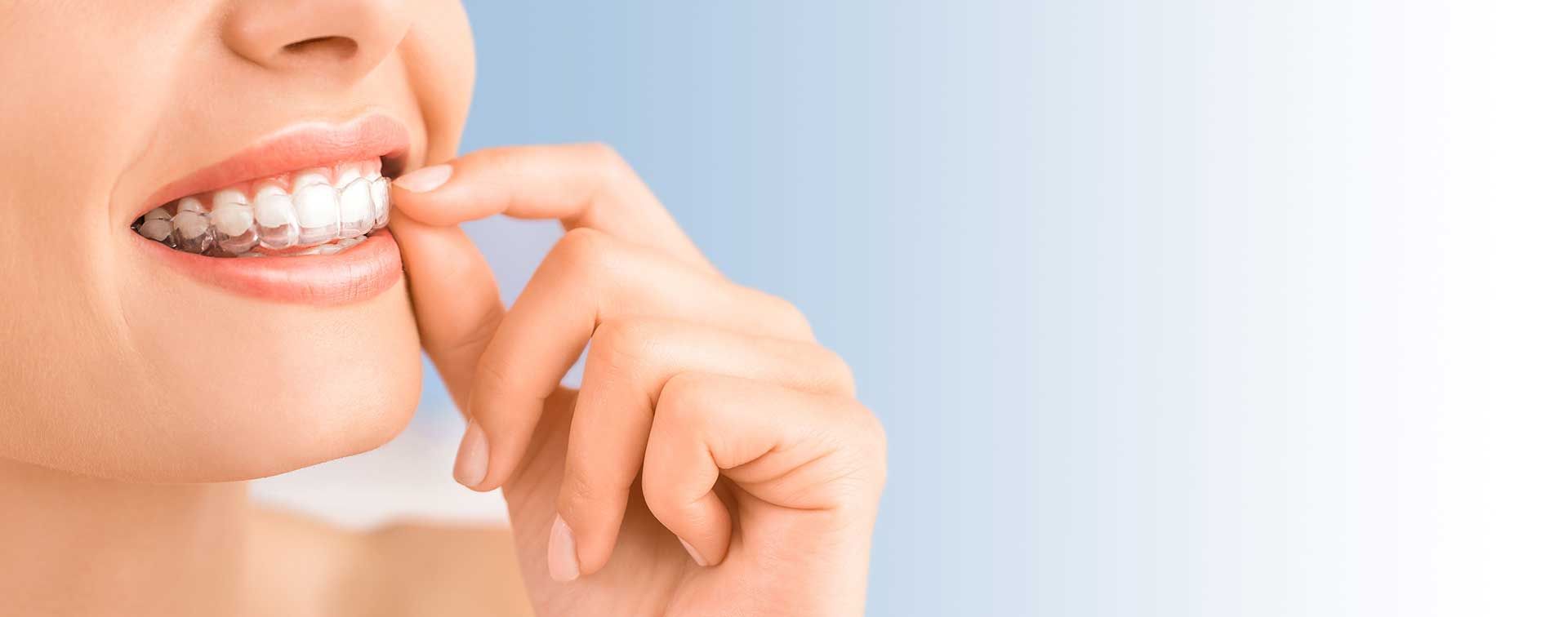 Hand placing a clear aligner on smiling teeth against a white background