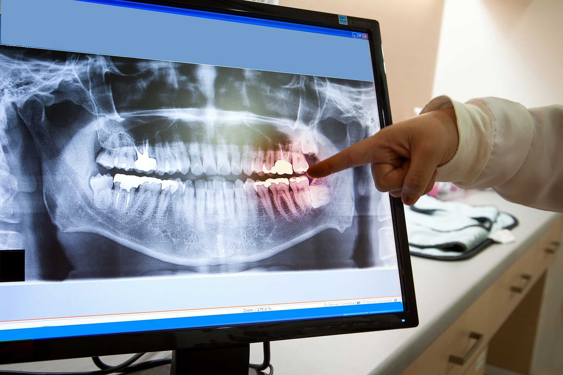 X-ray displayed on a monitor while a hand points to a red-highlighted area of the jaw