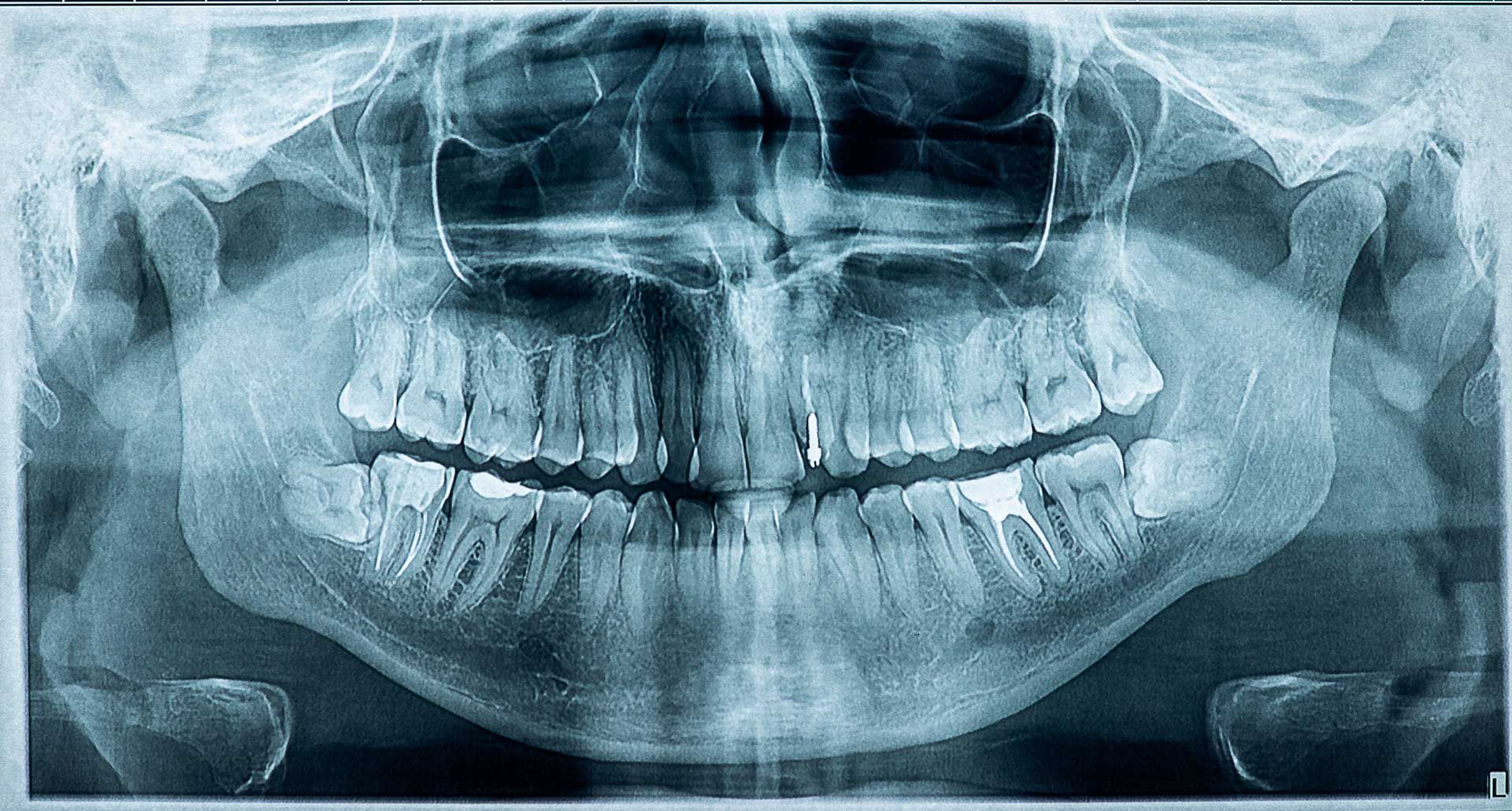 Panoramic dental X-ray showing the full upper and lower teeth and jawbones