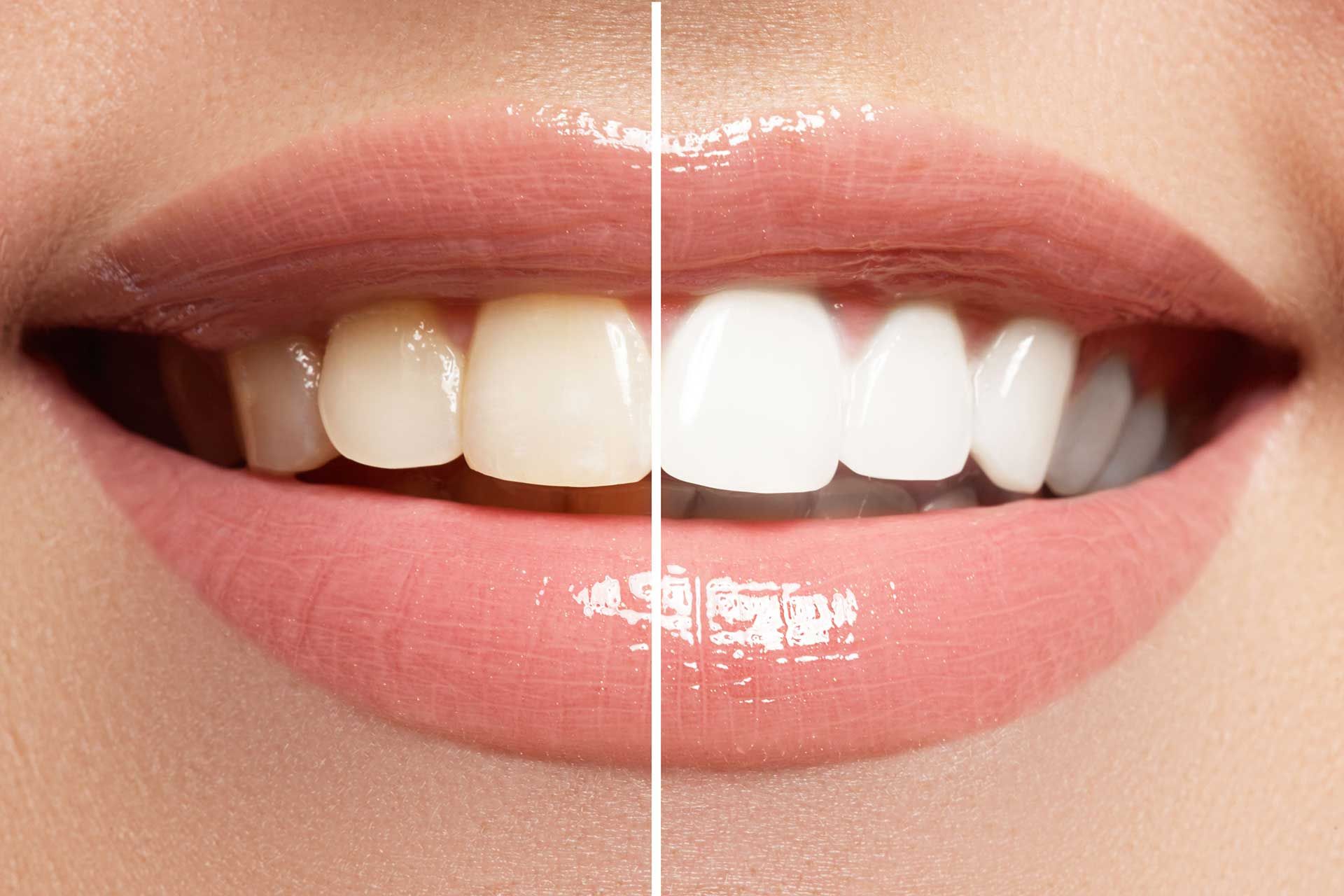 Close-up of lips and teeth split between yellowed and bright white after whitening treatment