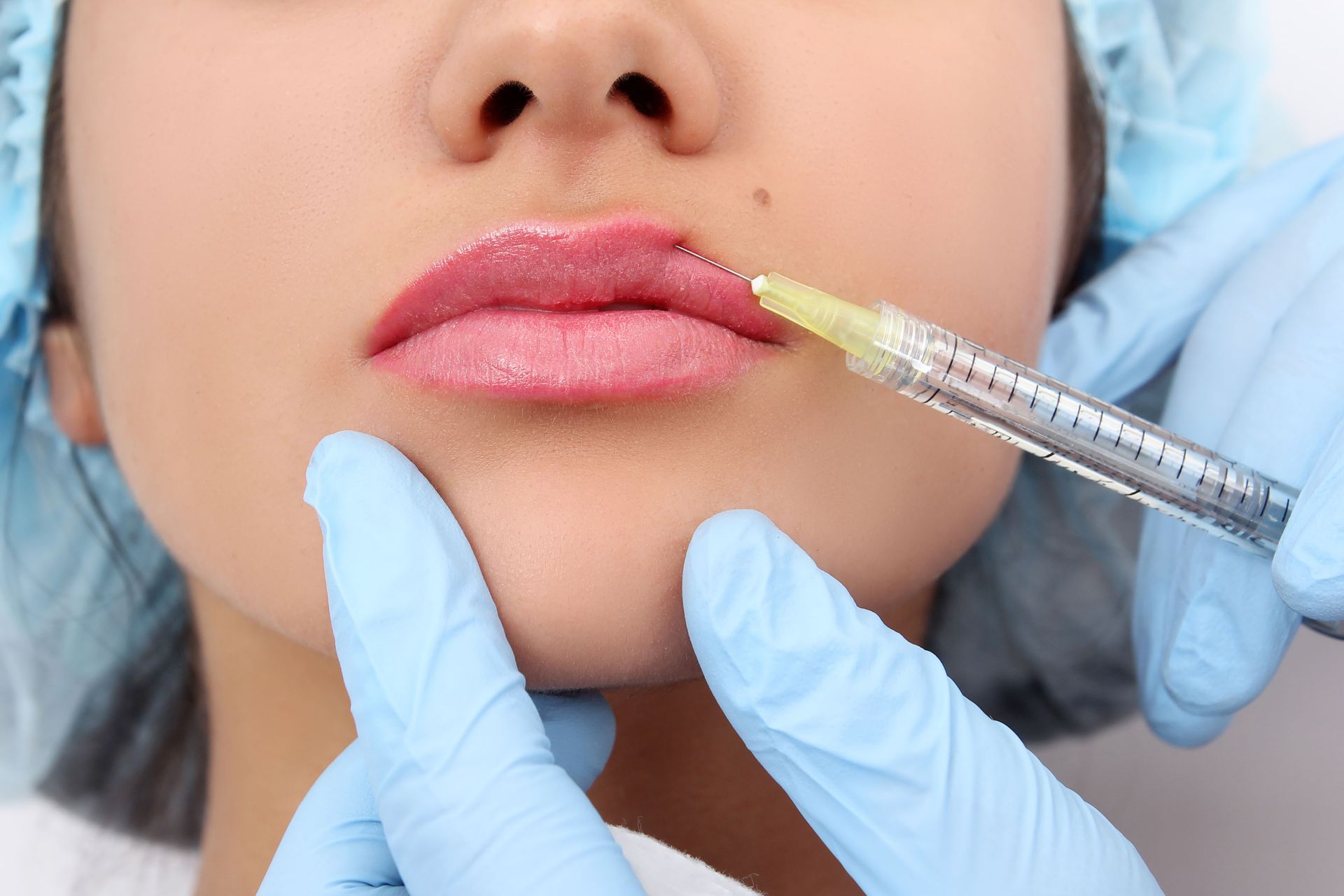 Person receiving lip filler injections, hands with blue gloves holding a syringe.