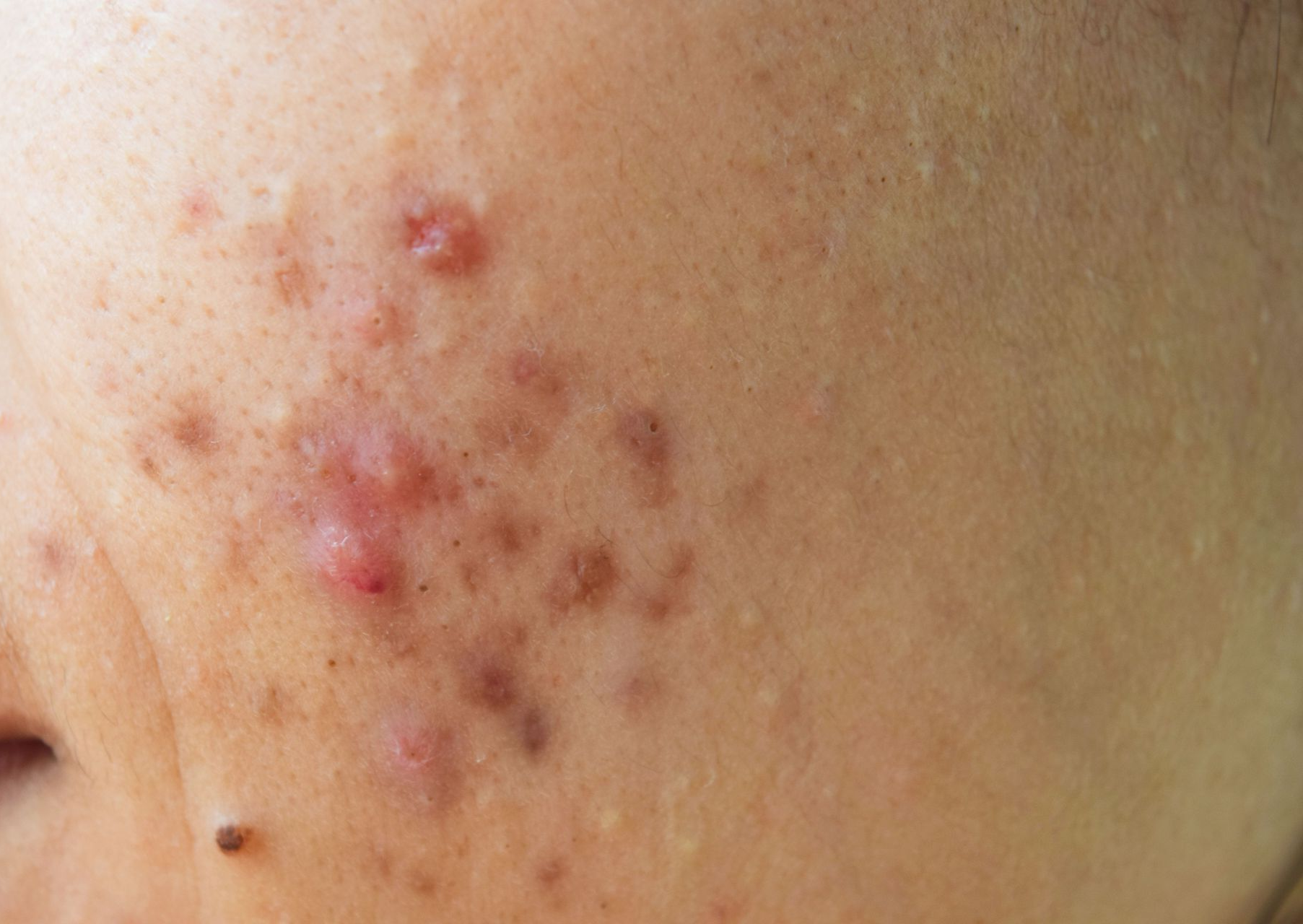 Close-up of skin showing acne lesions in various stages of healing on a person's face.