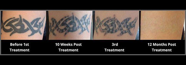 Tattoo Removal Healing Process