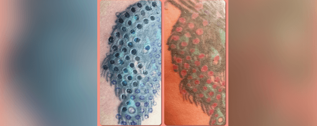 Tattoo Removal Process