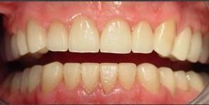 After 28 ceramic crowns