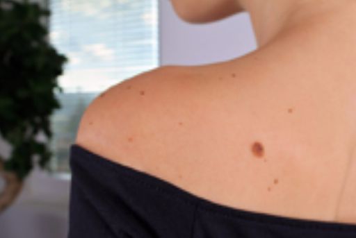 Shoulder and back of a person with several moles. Wearing a black off-the-shoulder top.