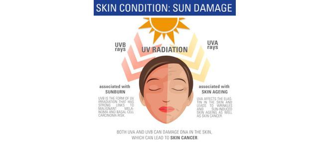 Diagram showing sun damage. Half of a face is sunburned, other half shows signs of aging. Labels show effects of UVA/UVB rays.