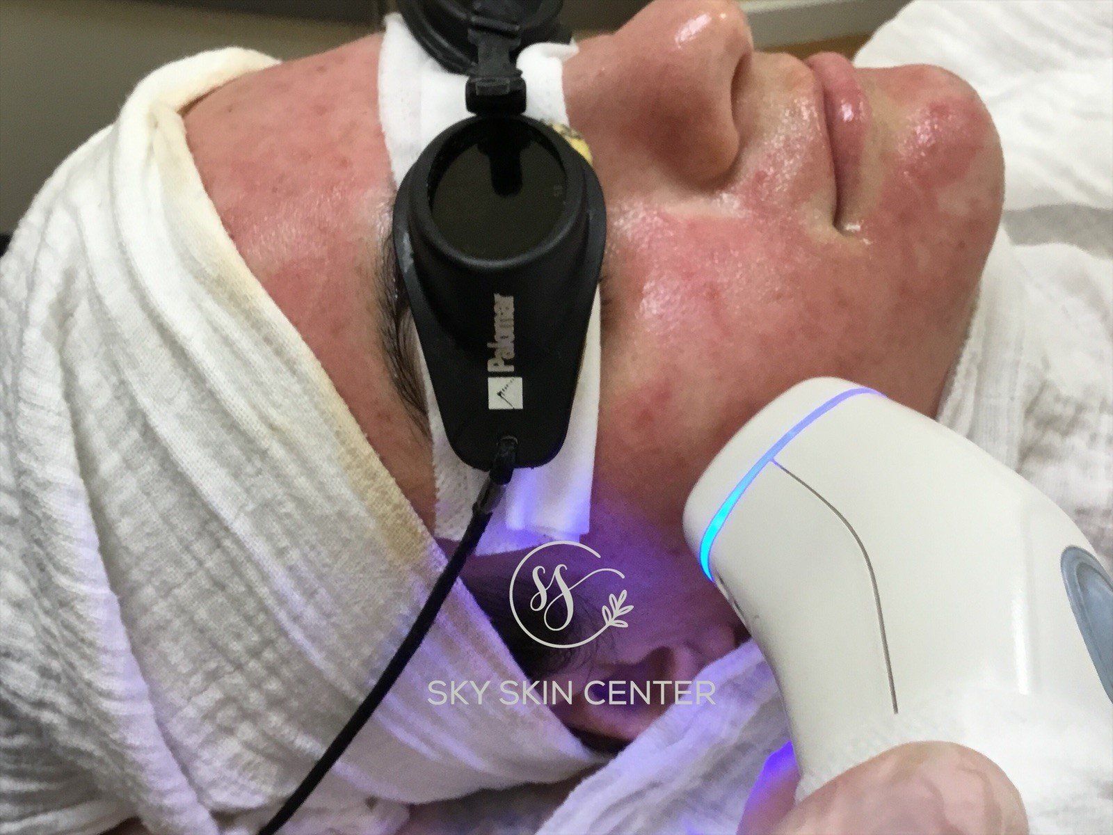 Fractional Treatment