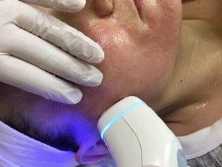 Fractional Treatment