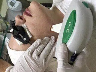 Photofacial Treatment