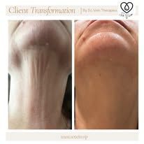 A before and after photo of a woman 's neck and neckline.