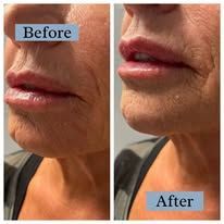 A before and after photo of a woman 's lips.