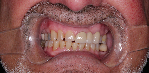 A close up of a man 's mouth with braces on his teeth.