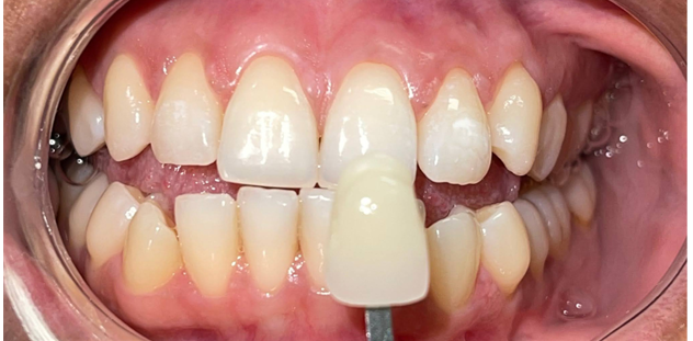 A close up of a person 's teeth with a mirror in the mouth.