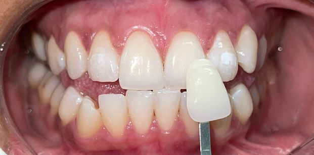 A close up of a person 's teeth with a tooth shade being taken.