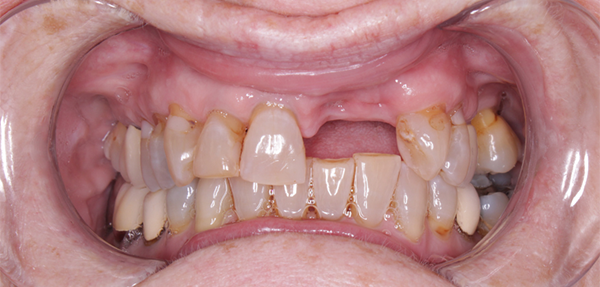 A close up of a person 's mouth with a missing tooth.