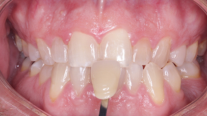 A close up of a person 's teeth with a tooth missing.