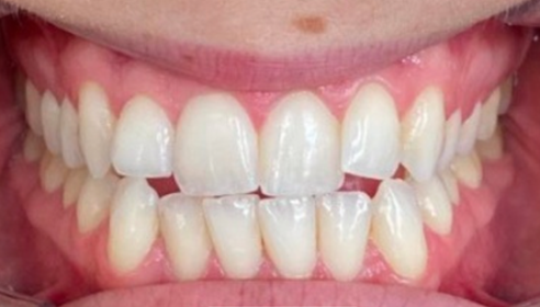 A close up of a person 's teeth with white teeth.