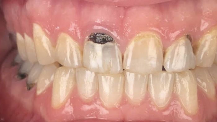 A close up of a person 's teeth with a tooth missing.