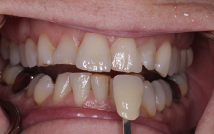 A close up of a person 's teeth with a toothbrush in their mouth.