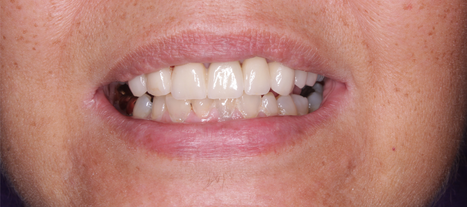 A close up of a woman 's mouth with white teeth.