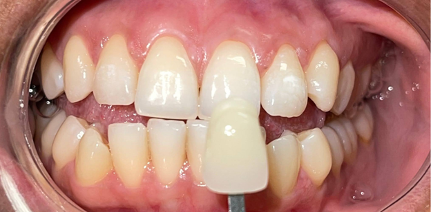 A close up of a person 's teeth with a mirror.