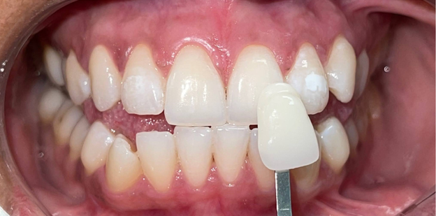 A close up of a person 's teeth with a tooth shade being taken.