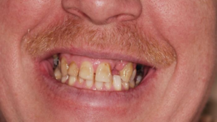A close up of a man 's mouth with a missing tooth.