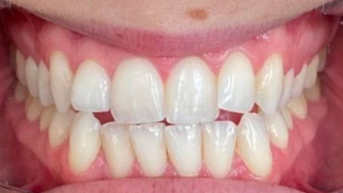 A close up of a person 's teeth with white teeth.