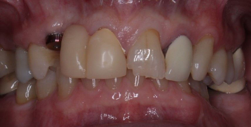 A close up of a person 's teeth with a missing tooth.