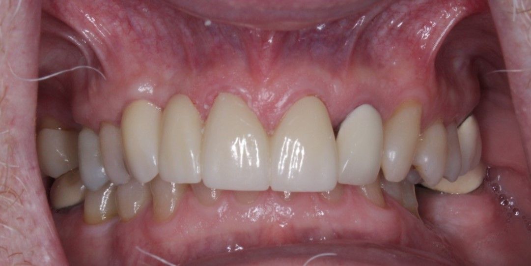 A close up of a person 's teeth with a missing tooth.