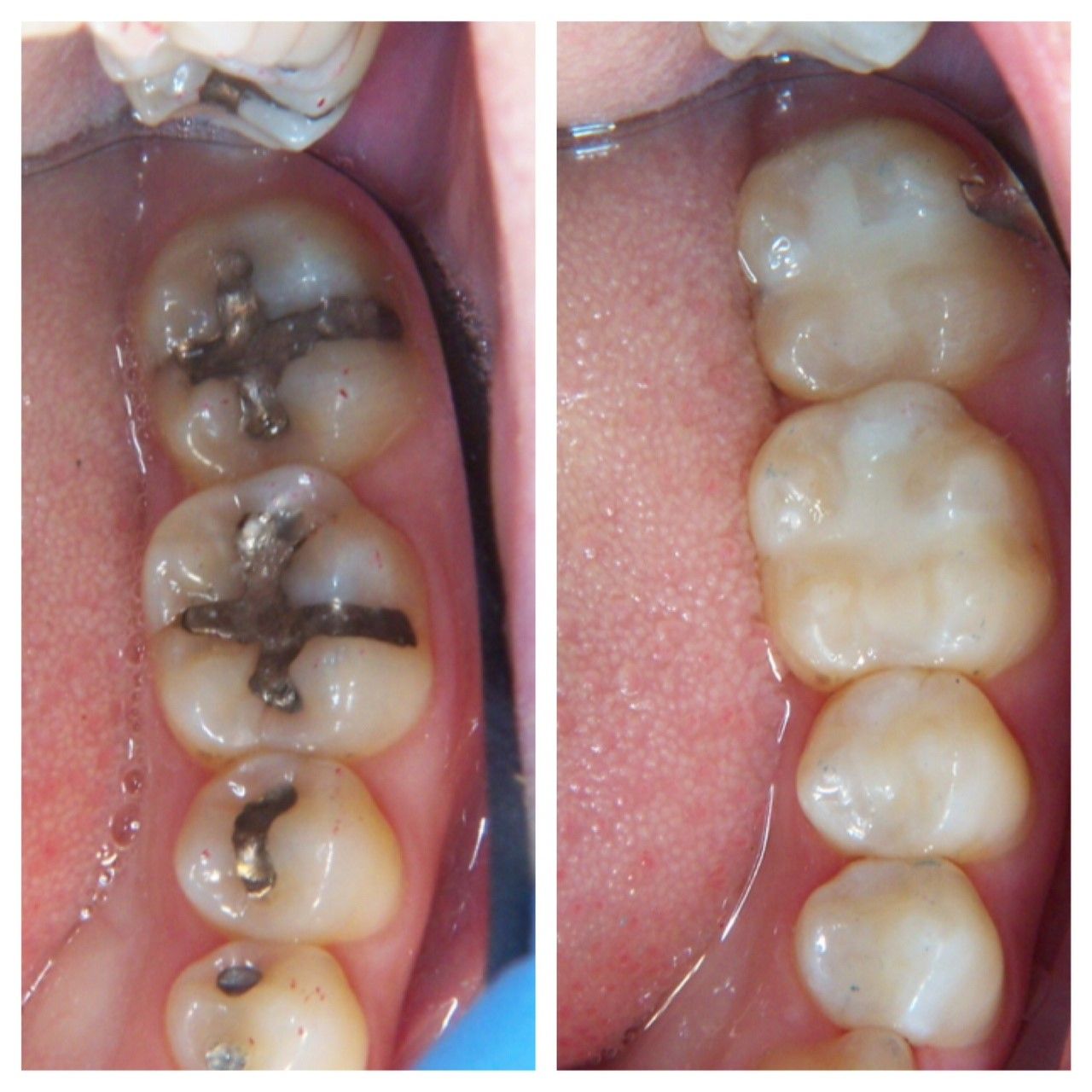 A before and after picture of a person 's teeth