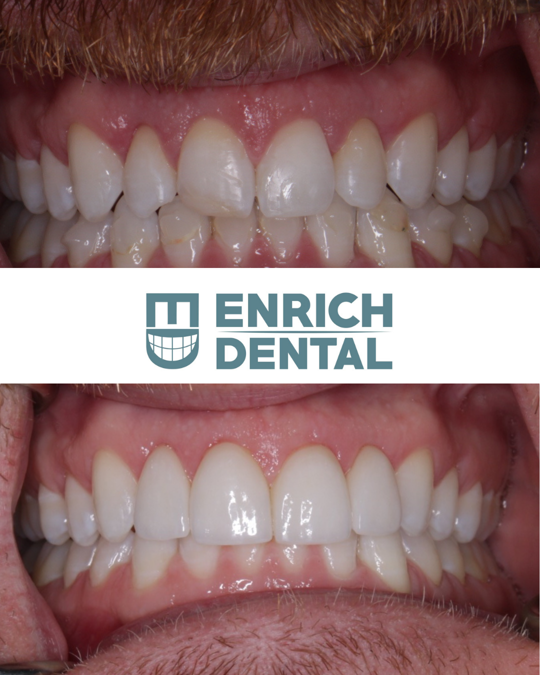 A before and after picture of a man 's teeth from enrich dental
