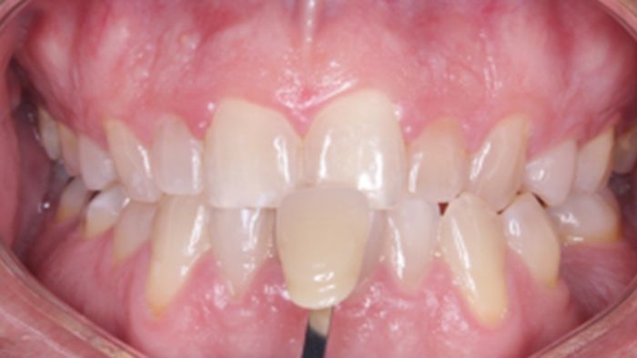 A close up of a person 's teeth with a tooth missing.