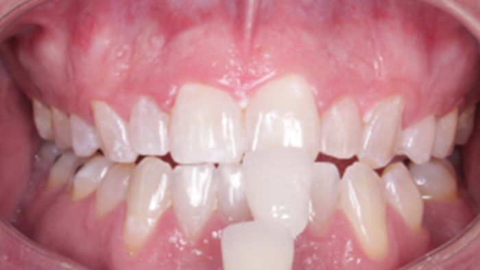 A close up of a person 's mouth with white teeth