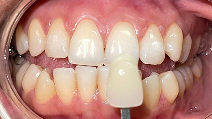 A close up of a person 's teeth in a mouth mirror.