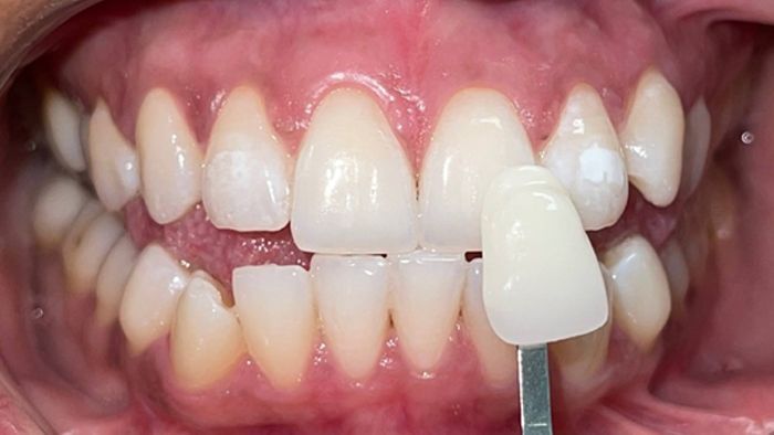 A close up of a person 's teeth with a tooth shade being taken.