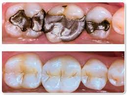 A before and after picture of a person 's teeth.